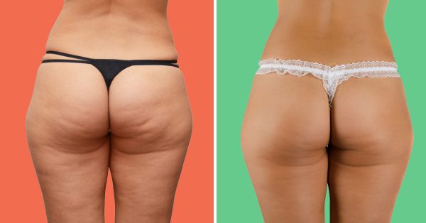 Картинки по запросу ցելյուլիտի մասին